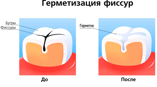 Фиссуры зубов схема