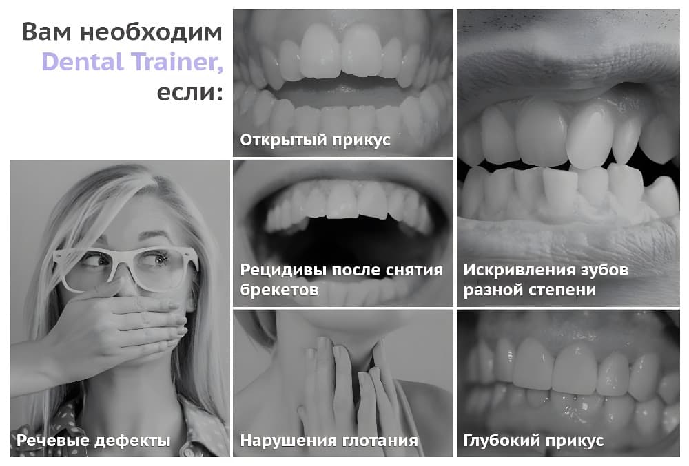 Откроюсь после. Открытый прикус трейнер. Исправление глубокого прикуса трейнерами. Открытый прикус с элайнерами. Трейнер для зубов до и после.