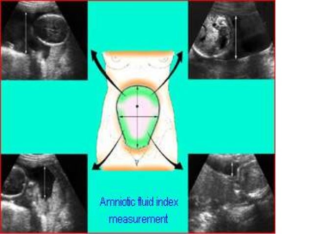Максимальный вертикальный. Измерение околоплодных вод на УЗИ. Измерение количества околоплодных вод. Оценка индекса амниотической жидкости. Измерение ИАЖ на УЗИ.