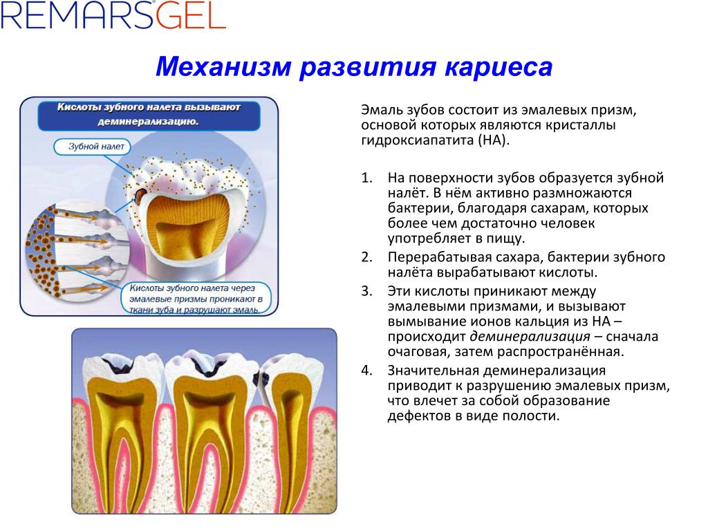 Виды эмали зуба. Механизм возникновения кариеса. Очаговая деминерализация эмали: механизмы. Кариес зубов механизм развития. Схема механизм деминерализации эмали.