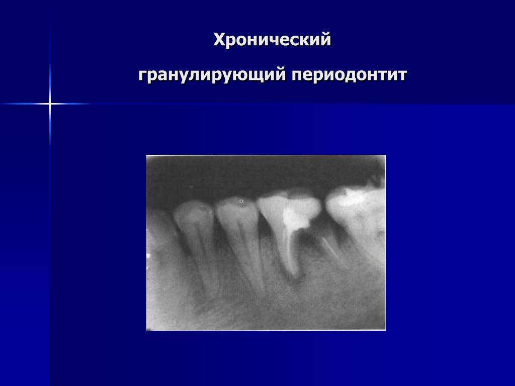 Хронический фиброзный периодонтит лечение. Фиброзный периодонтит рентгенограмма. Гранулематозный апикальный периодонтит. Гранулематозный периодонтит рентген.