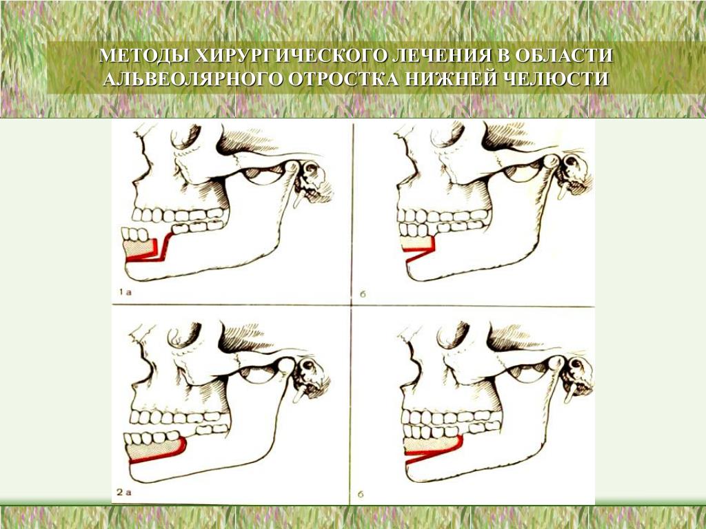 Переломы нижней челюсти стоматология презентация