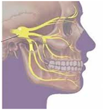 Лицевой нерв челюсти. Неврит Нижнего луночкового нерва. Тройничный нерв и перелом челюсти. Тригеминальная невралгия ВНЧС. Неврит нижнечелюстного нерва.