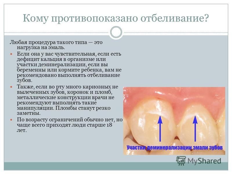 Деминерализация эмали фото