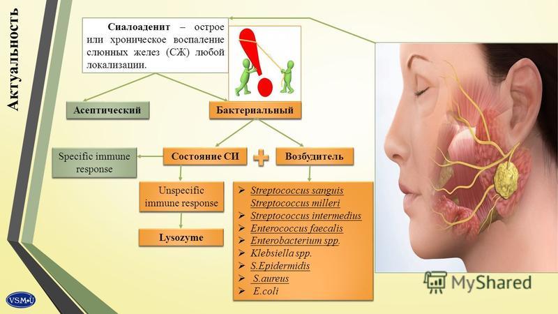 Лечение сиалоаденита