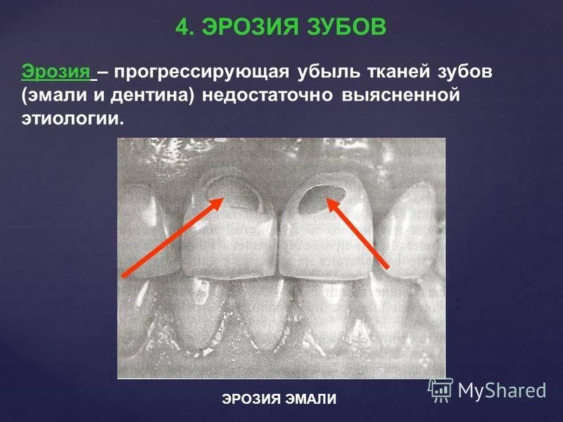 Патология твердых тканей. Эрозия твердых тканей зубов. Гипоплазия эмали эрозивная форма. Некариозное поражение эмали флюороз.