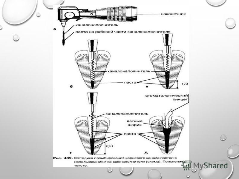 Адгезивная технология пломбирования. Методика ручного пломбирования корневого канала пастой. Инжекторный метод пломбирования каналов.