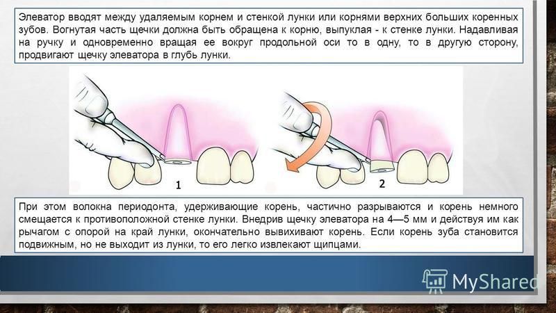 Через сколько после удаления зуба можно есть. Как удаляют корешок зуба. Удаление корня зуба элеватором. Как удаляют зуб элеватором. Элеватор для удаления зубов мудрости.