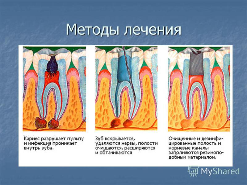 Лечение кариеса постоянных зубов у детей презентация