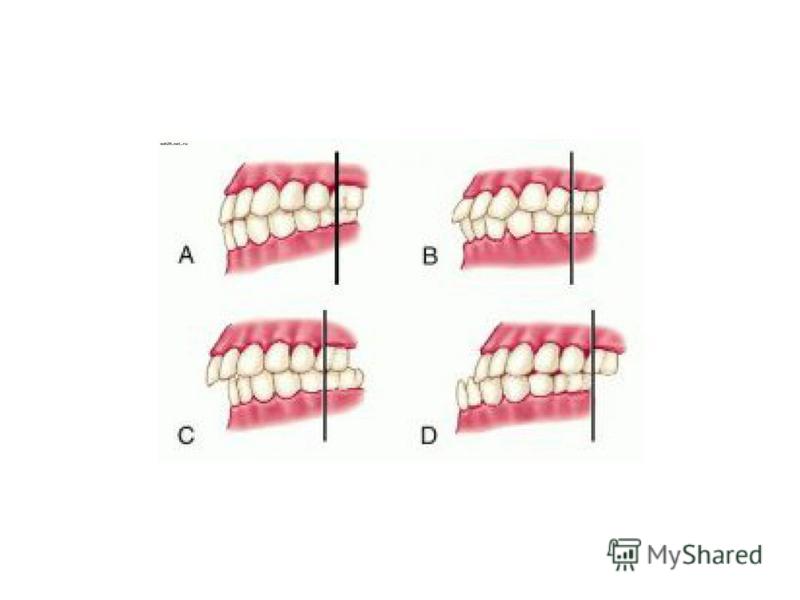 Неправильный прикус виды. Неправильный прикус вид сбоку. Идеальный прикус сбоку. Дистальный прикус сбоку. Правильный прикус сбоку.