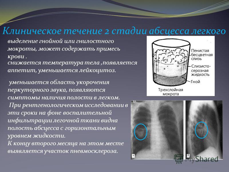 Серозная жидкость. Мокрота при абсцессе легкого. Анализ мокроты при абсцессе легкого. Мокрота при абсцессе легких:. Мокрота при абсцессе лёгкого.