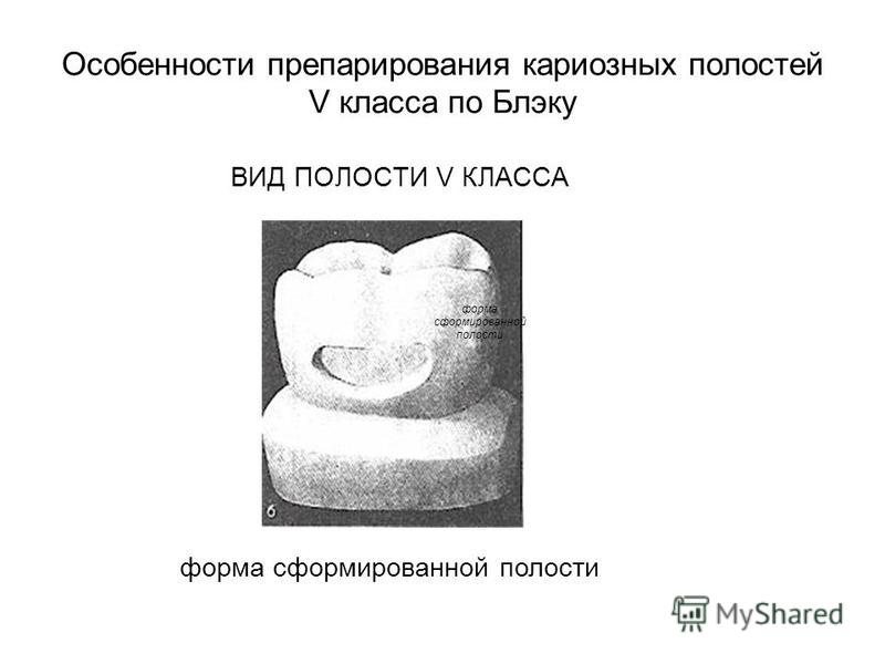 Сколько лет блэку. Препарирование пятого класса по Блеку. Препарирование полостей 1 класса по Блэку. Препарирование кариозных полостей 5 класса по Блэку. Препарирование полостей v класса по Блеку.