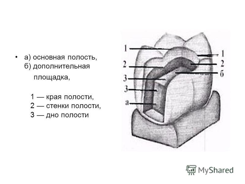 Полость впервые. Элементы отпрепарированной кариозной полости. Дополнительная площадка при препарировании кариозной полости. Этапы препарирования 1 класса. Препарирование кариозных полостей 1 и 5 классов.