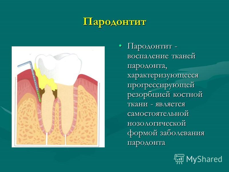 Периодонтит детская стоматология презентация