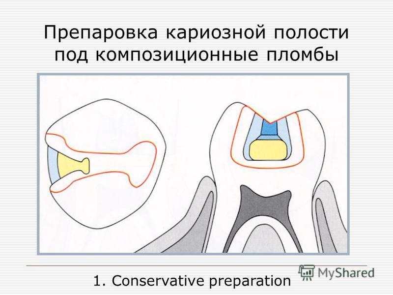 Края кариозной полости. Подготовка кариозных полостей 1 класса под композитных пломб. Препарирование кариозных полостей. Расширение кариозной полости. Формирование кариозной полости.