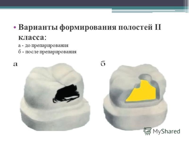 Классы по блэку. Классификация кариозных полостей по Блэку. Формирование полостей по Блэку. Формирование полости кариозной полости 2 класса. Варианты формирования полостей 2 класса.