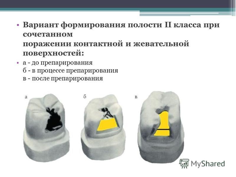 Локализация кариозных полостей