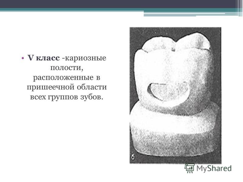 Кариозные полости 5 класса. Препарирование полостей 5 класса по Блэку. Кариозная полость 5 класса по Блэку. Классы по Блэку в стоматологии в картинках препарирование с зубами. 5 Класс препарирования по Блэку 5 зуба.