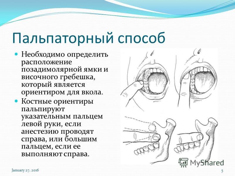 Мандибулярная анестезия в стоматологии схема проведения видео