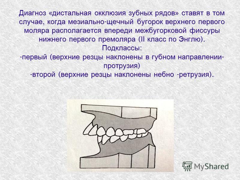 Правая окклюзия. Мезиальная окклюзия класс по Энглю. Дистальная окклюзия 2 подкласс. Дистальная окклюзия зубных рядов. Дистальная окклюзия по Энглю.