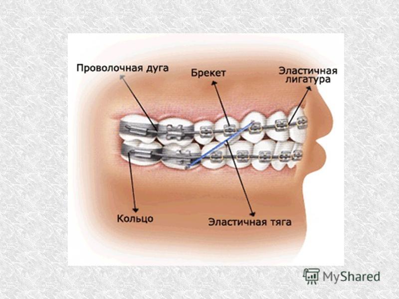 Эластичная лигатура. Схемы эластиков YF ,htrtmf[. Элементы конструкции брекет систем. Конструкция брекетов. Конструкция брекет системы.