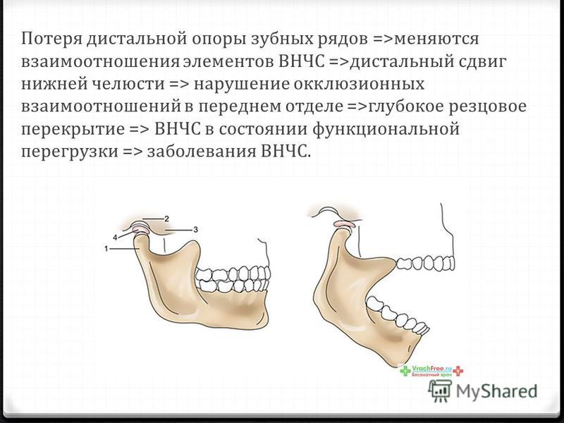 Почему нижняя челюсть. Дистальный отдел нижней челюсти. Дистальный сдвиг нижней челюсти. Дистальное смещение нижней челюсти. Движение нижней челюсти в височно нижнечелюстном суставе.