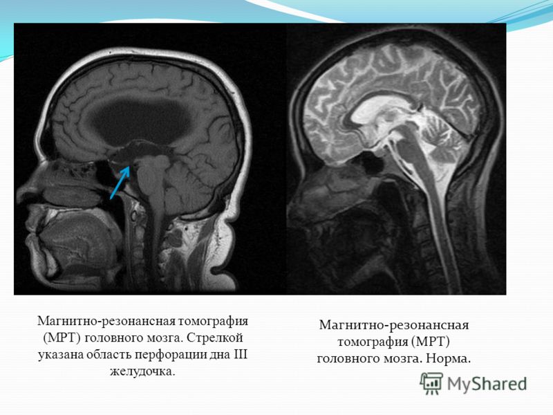 Норма мозга. Мрт желудочков головного мозга в норме. Мрт мозга норма. Мрт норма анатомия головного мозга. Желудочки головного мозга мрт.