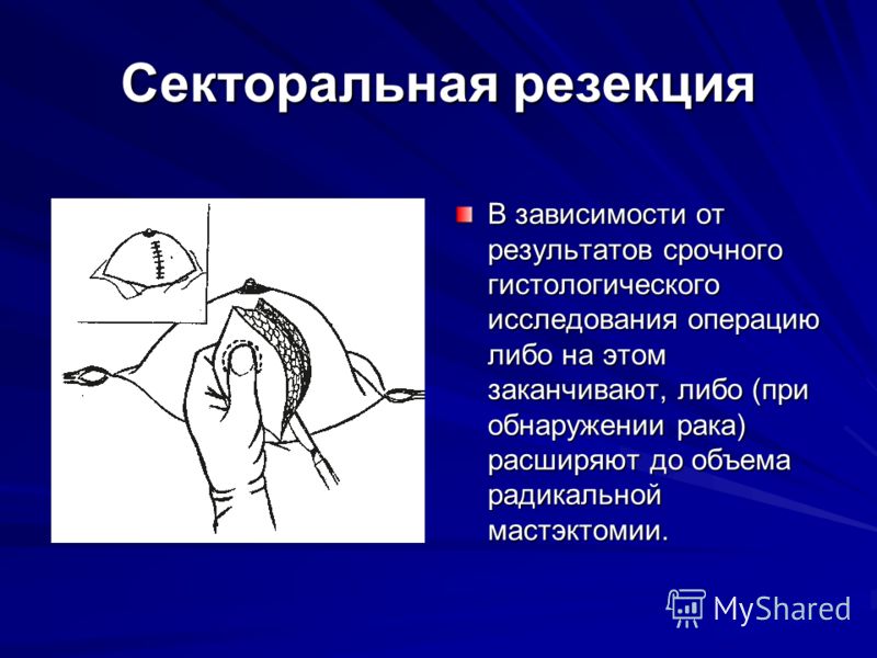 Секторальная резекция. Секторальная резекция молочной железы протокол операции. Секторальная резекция молочной. Секторальная резекция грудной железы. Радикальная секторальная резекция молочной железы.