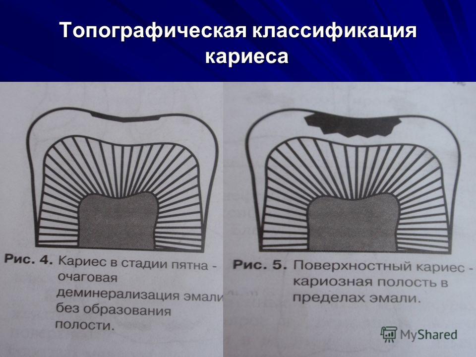 Классификация кариеса