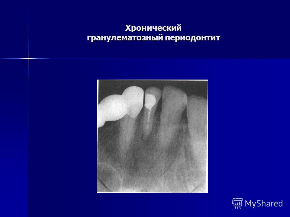 Фиброзный периодонтит