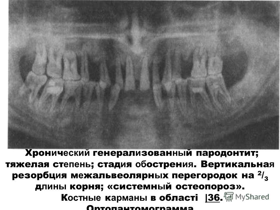 Рентгенологическая картина костной ткани челюстей при пародонтите тяжелой степени