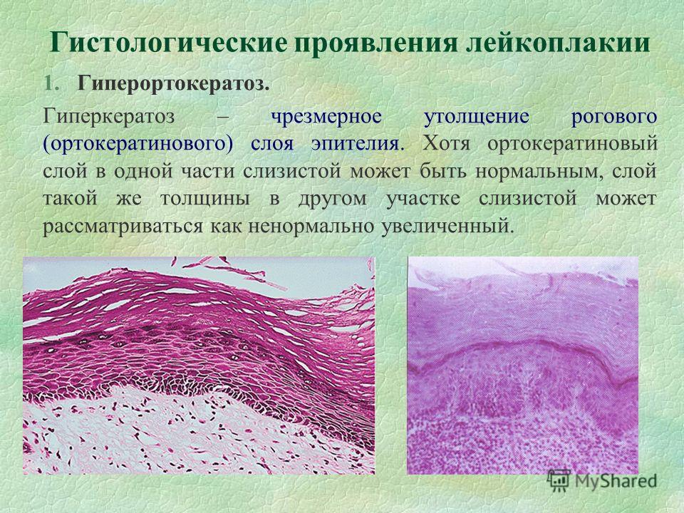 Волосистая лейкоплакия языка фото