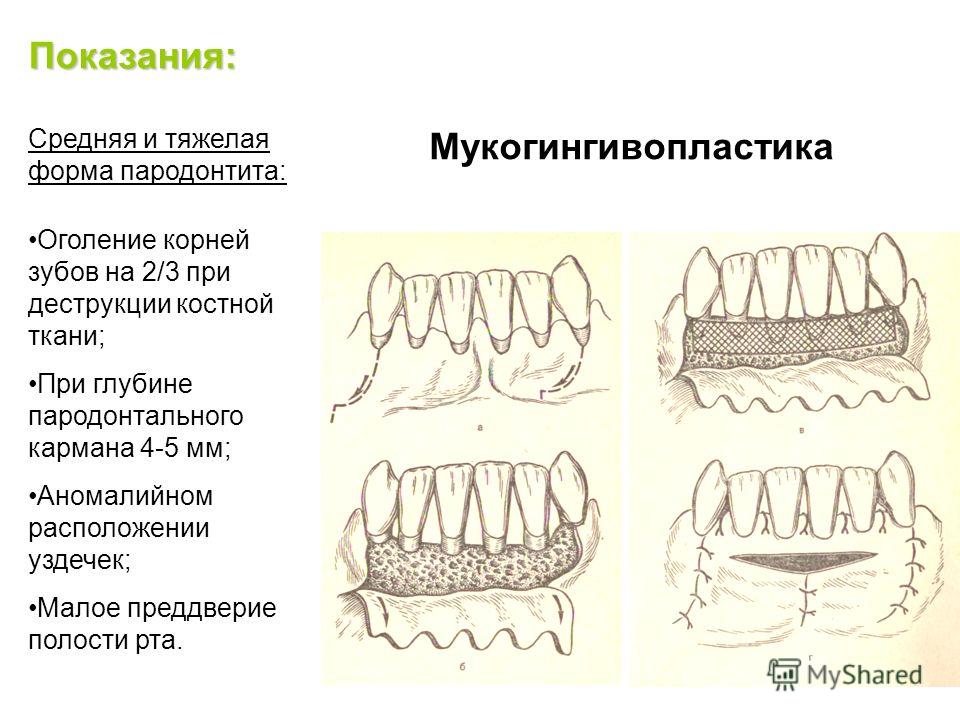 Пародонтит костная ткань