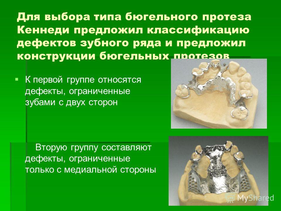 Дефекты бюгельных протезах на верхнюю челюсть. Конструктивные элементы бюгельных протезов. Бюгельный протез классификация.