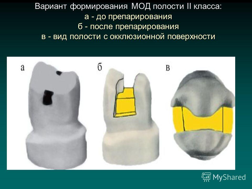 Классы по блэку в стоматологии в картинках