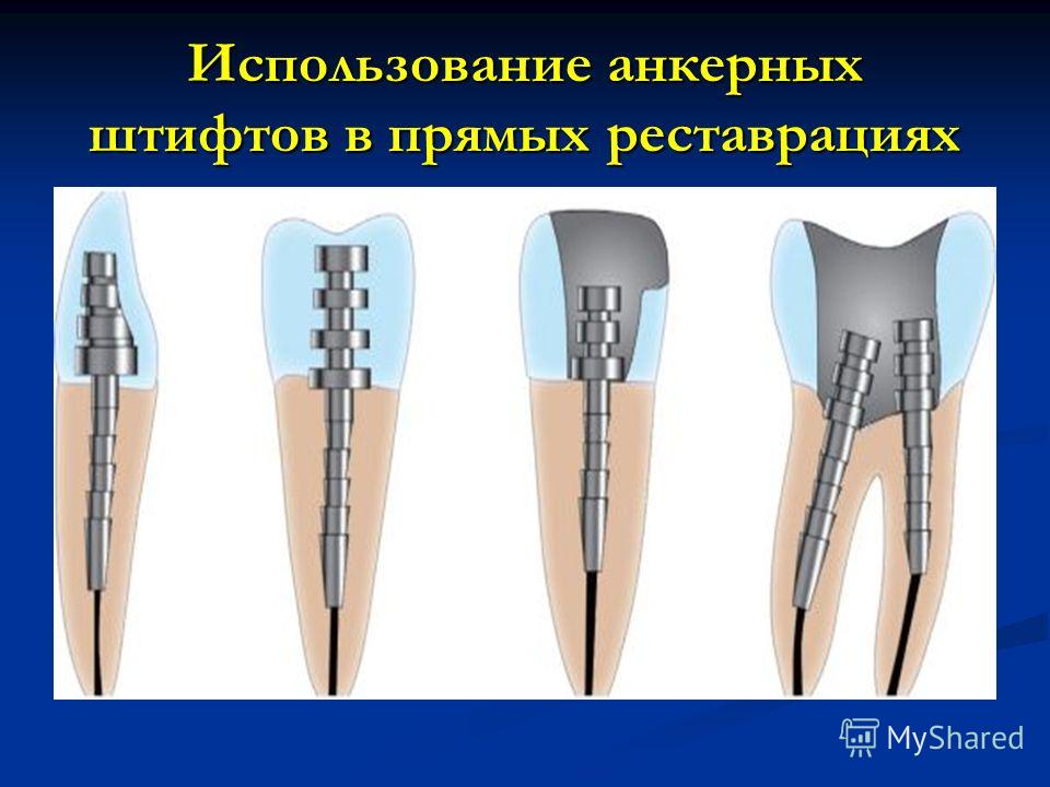 Штифт зубной картинка