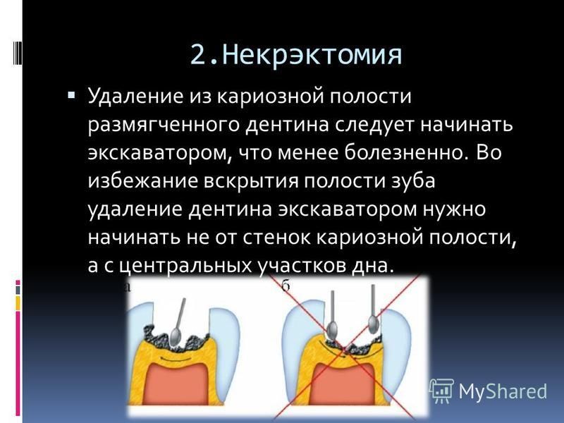 Дополнительные площадки кариозной полости