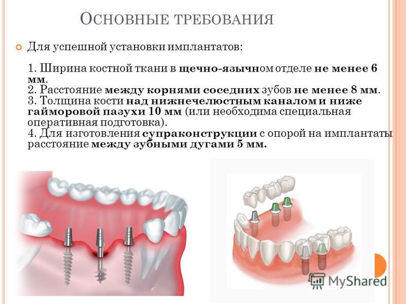 Больно ли ставить импланты отзывы