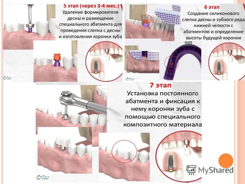 Слепок с формирователем десны. Индивидуальный формирователь десны изготовление. Гипсовый абатмент чек на формирователи десны.