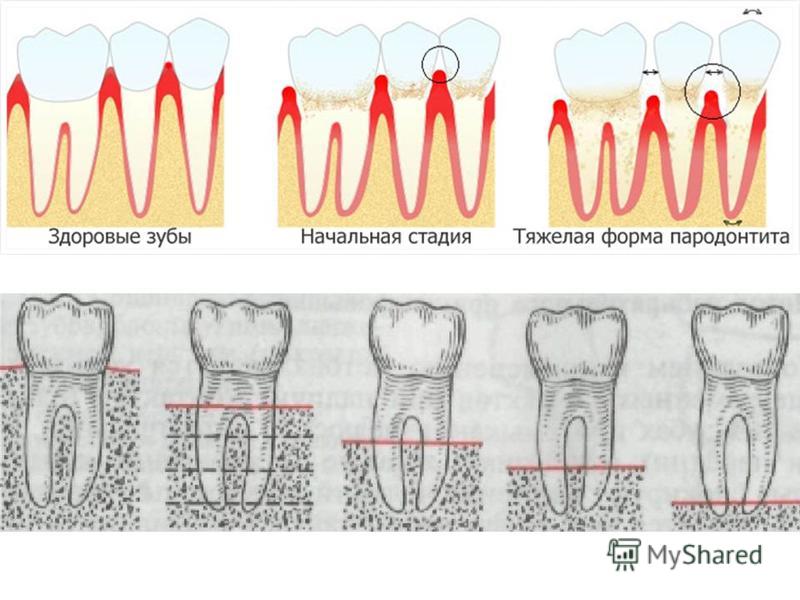Пародонтит рентгенологическая картина
