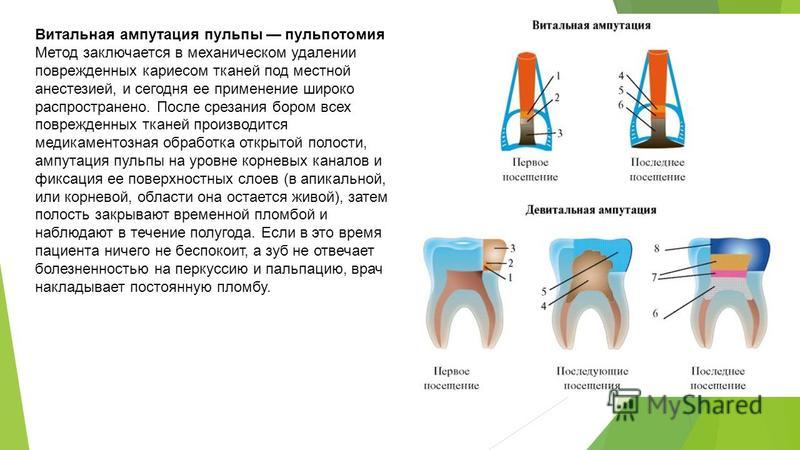 Витальная ампутация пульпита