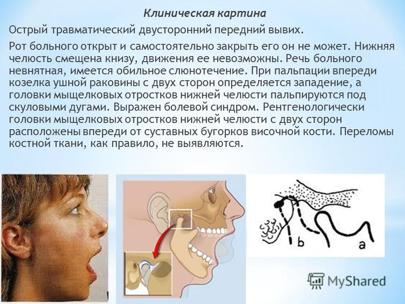 Вывих челюсти. Двусторонний вывих нижней челюсти. Двусторонний передний вывих нижней челюсти. Односторонний вывих нижней челюсти характеризуется. Острый вывих нижней челюсти.