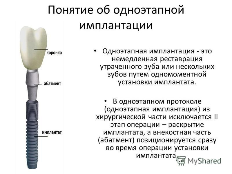 Имплантация схема установки зубов