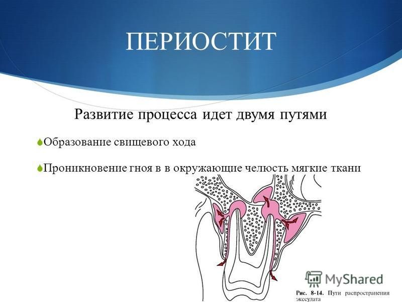 Periostitis латынь