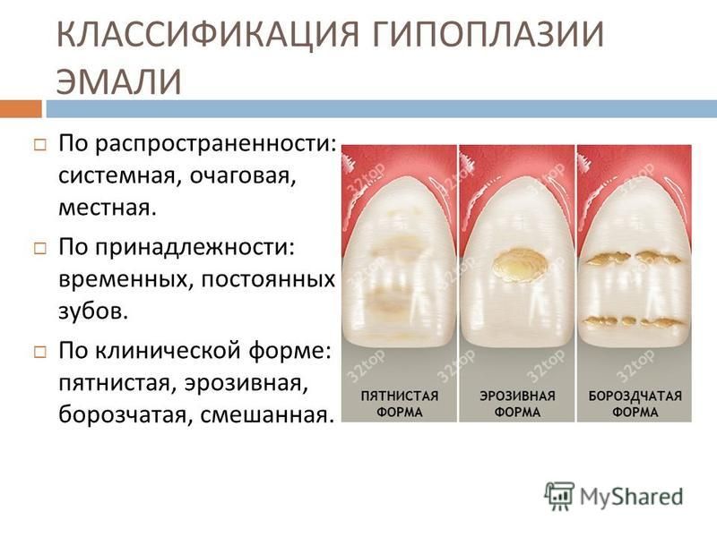 Почему зубы отличаются. Гипоплазия эмали системная местная очаговая. Системная гипоплазия эмали эрозивная форма. Формы системной гипоплазии эмали. Системная гипоплазия пятнистая форма.