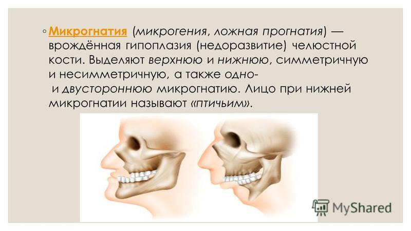 Prognathia латынь. Недоразвитие верхней челюсти. Микрогения и микрогнатия. Прогнатия верхней и нижней челюсти.