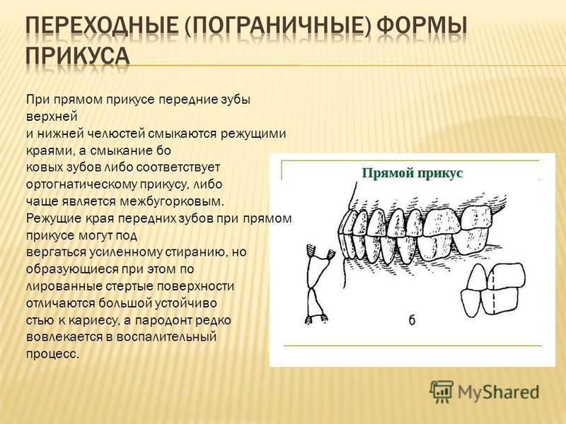 Окклюзия симптомы. Ортогнатический и прямой прикус. Физиологический прямой прикус. Прямой прикус окклюзия.