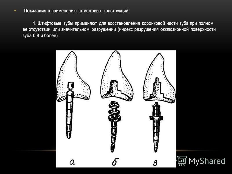 Штифтовые зубы. Индекс разрушения окклюзионной поверхности зуба ИРОПЗ. Разрушение коронковой части зуба ИРОПЗ. Индекс разрушения окклюзионной поверхности коронки зуба. Милинкевич ИРОПЗ.