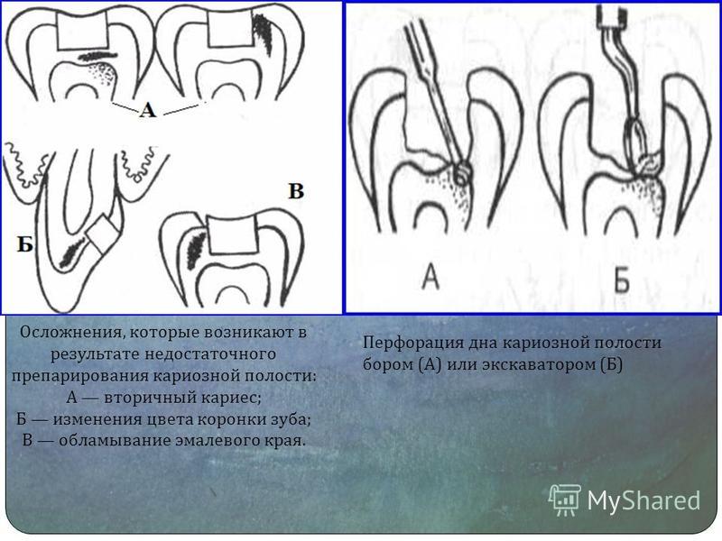 Полость привести. Ошибки препарирования кариозных полостей. Осложнения при препарировании кариозных полостей. Перфорация пульпы зуба при кариесе. Перфорация дна зуба при препарировании.