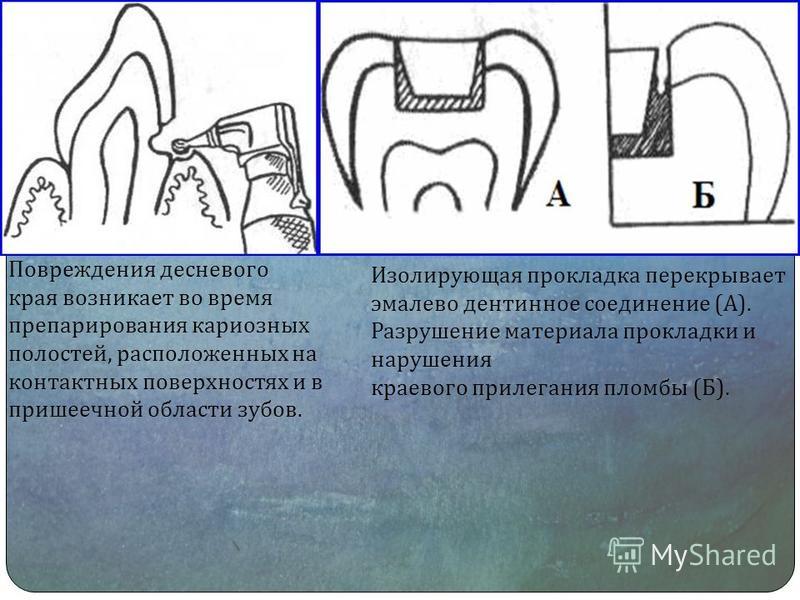 Способы препарирования кариозных полостей. Повреждение десневого края при препарировании. Осложнения при препарировании кариозных полостей.